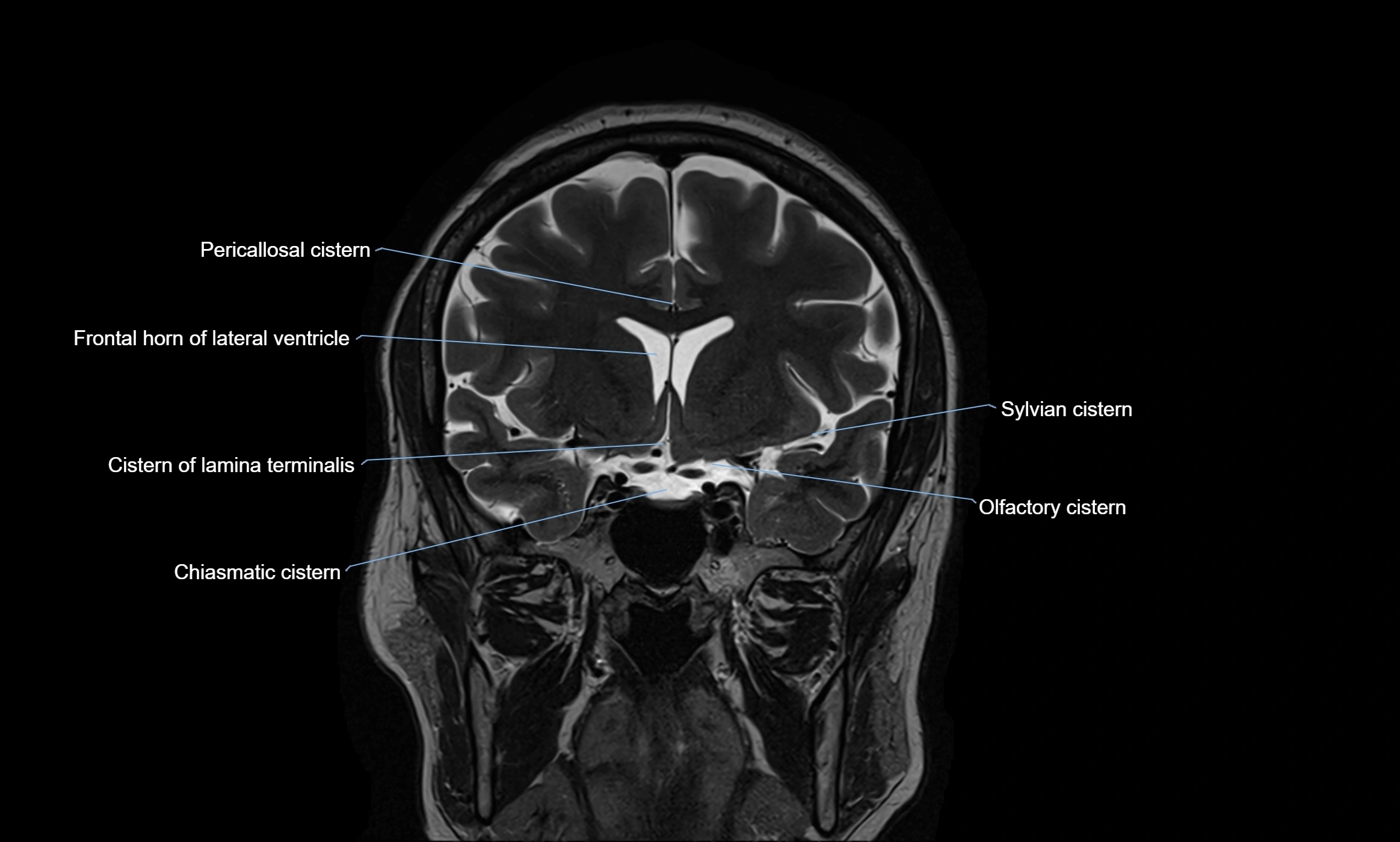Brain cisterns  and ventricles coronal anatomy 3T MRI image-img-00001-00020.webp